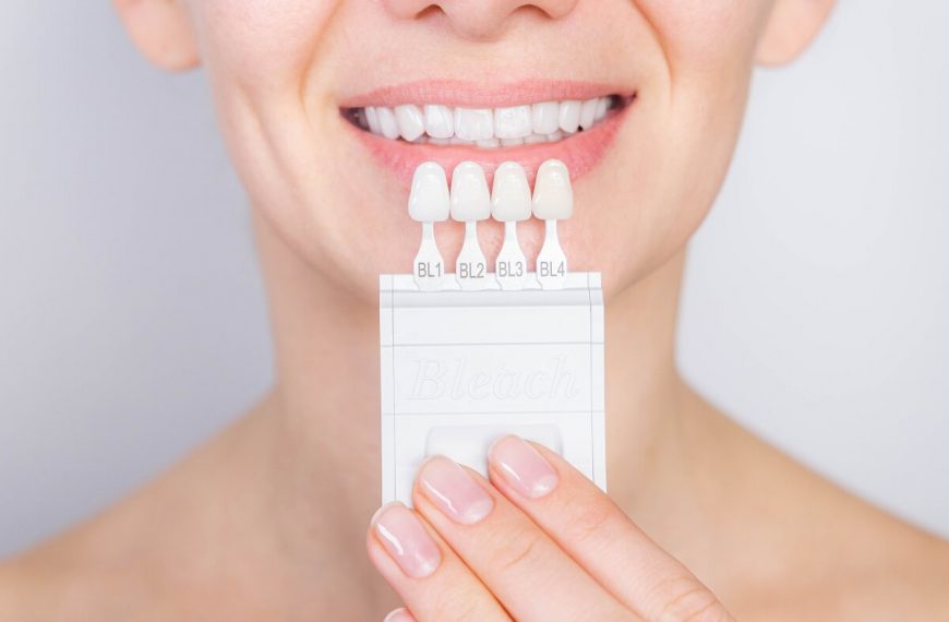 How Long Veneers Will Last