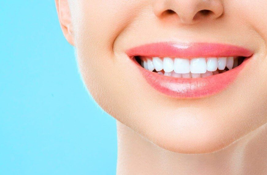 Teeth Whitening Is Best Done At A Canberra Dental Care Clinic